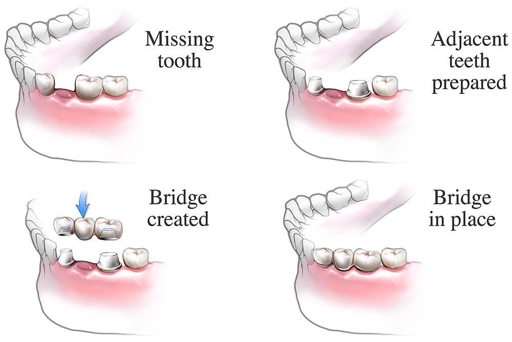 Dental Bridges Paddington Dentures Paddington