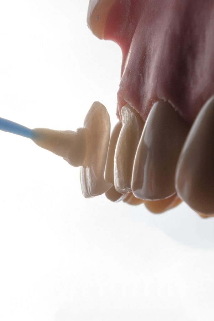Fixing an Imperfect Smile Can Be Simple With Dental Veneers