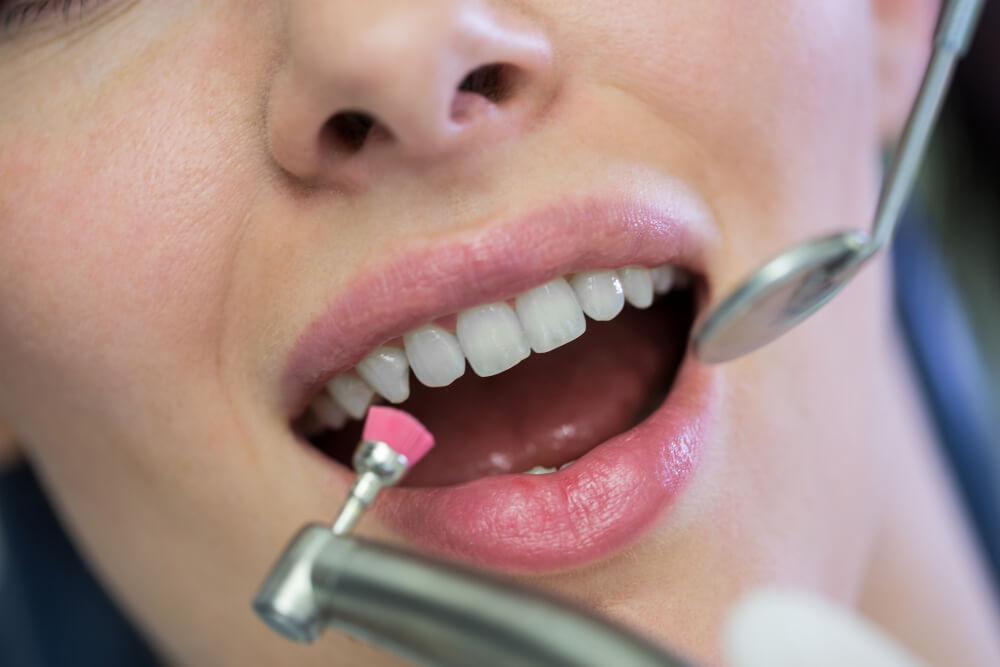 What Type of Teeth Veneers Last the Longest?